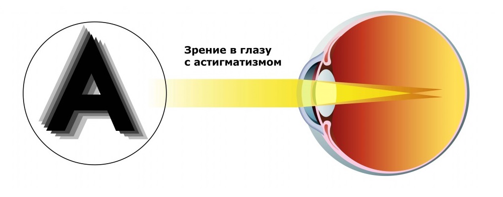 Как видит глаз с астигматизмом